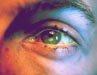 Image of bruised and reddened man's eye